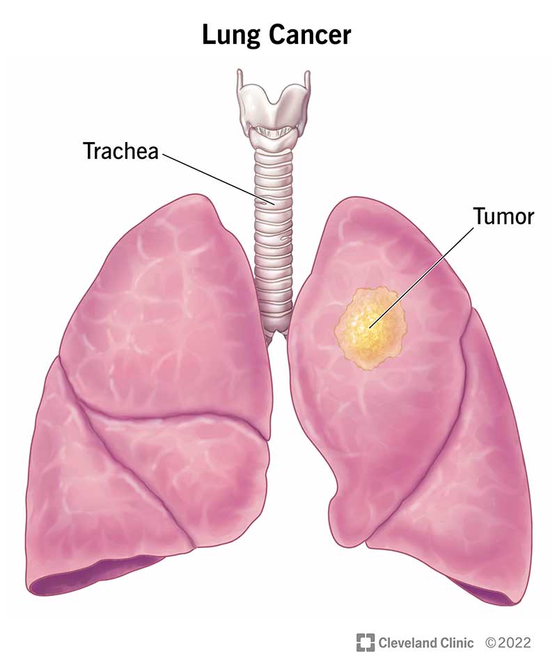 Radonul și cancerul de plămâni
